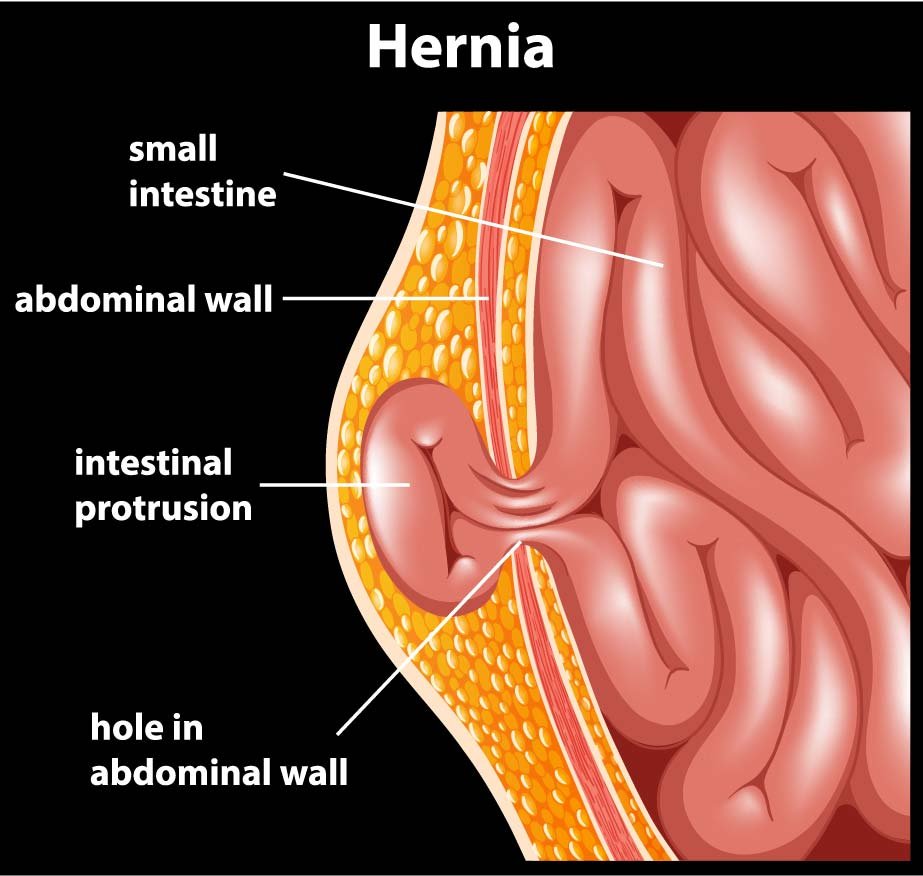 hernia 02